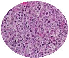 lymphoma